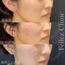 当院人気No1🌟ホクロ３個18,000円 before画像 サムネイル用