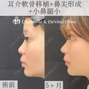 鼻の印象をなくして忘れ鼻に before画像 サムネイル用