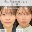 鼻の印象をなくして忘れ鼻に after画像 サムネイル用