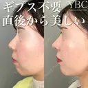 【🐼鼻尖形成🐼】 after画像 サムネイル用