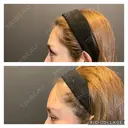 ヒアルロン酸注入　額 after画像 サムネイル用