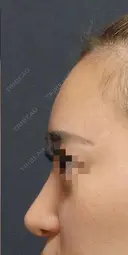 Sライン形成: 額 脂肪注入 after画像 サムネイル用