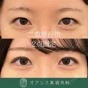二重埋没 before画像 サムネイル用