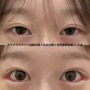 皮膚を切らない後戻り最小のグラマラスライン（グラマラスライン結膜切開＋目尻切開＋目尻靭帯移動） 30日後 サムネイル用