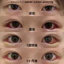 皮膚を切らない後戻り最小のグラマラスライン（グラマラスライン結膜切開＋目尻切開＋目尻靭帯移動） after画像 サムネイル用