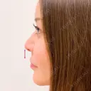 人中短縮で美人顔を手に入れる♪【ヒアルロン酸鼻中隔延長・人中短縮】 before画像 サムネイル用
