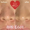 顔脱毛６回 before画像 サムネイル用