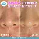 顔脱毛６回 180日後 サムネイル用
