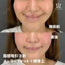 笑った時の頬の盛り上がりが気になる33歳女性の脂肪吸引注射 before画像 サムネイル用