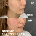 笑った時の頬の盛り上がりが気になる33歳女性の脂肪吸引注射 after画像 サムネイル用