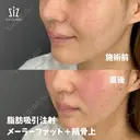 笑った時の頬の盛り上がりが気になる33歳女性の脂肪吸引注射 after画像 サムネイル用