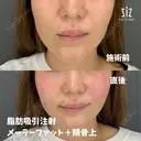 笑った時の頬の盛り上がりが気になる33歳女性の脂肪吸引注射 after画像 サムネイル用