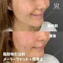 笑った時の頬の盛り上がりが気になる33歳女性の脂肪吸引注射 after画像 サムネイル用