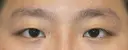 目力アップ+マイクロ脱脂+埋没法 before画像 サムネイル用