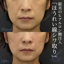 ヒアルロン酸注入（ほうれい線） after画像 サムネイル用