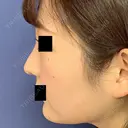 『　鼻尖形成術　』『　鼻尖部軟骨移植　』『　鼻翼縮小術　』 30日後 サムネイル用