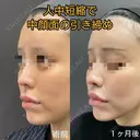 魅惑的な口元に💋人中短縮 30日後 サムネイル用