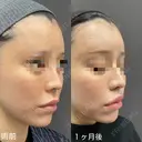 魅惑的な口元に💋人中短縮 30日後 サムネイル用