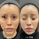 魅惑的な口元に💋人中短縮 30日後 サムネイル用