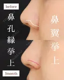 鼻孔縁挙上・人中短縮・小鼻縮小・鼻翼挙上 90日後 サムネイル用