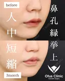 鼻孔縁挙上・人中短縮・小鼻縮小・鼻翼挙上 before画像 サムネイル用