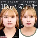 エラボトックス before画像 サムネイル用