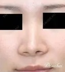 鼻尖縮小術+耳介軟骨移植 180日後 サムネイル用