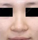 鼻尖縮小術+耳介軟骨移植 before画像 サムネイル用