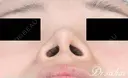 鼻尖縮小術+耳介軟骨移植 180日後 サムネイル用