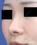 鼻尖縮小術+耳介軟骨移植 180日後 サムネイル用