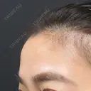 ぷるぷる注射 before画像 サムネイル用