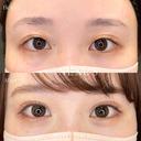 ネクサスアイズ(埋没法) before画像 サムネイル用
