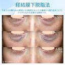 【40代女性・目の下のクマを切らずに解消】経結膜下脱脂術単独（4ヶ月後） before画像 サムネイル用