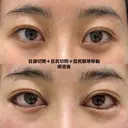 目頭切開＋目尻切開＋目尻靱帯移動 before画像 サムネイル用