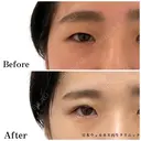 二重埋没法 after画像 サムネイル用