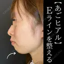 顎ヒアルロン酸（ボラックス） before画像 サムネイル用
