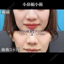 小鼻縮小（内側＋外側切開） 90日後 サムネイル用