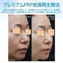 【40代女性・目の下とほうれい線で自然に若返り】プレミアムPRP皮膚再生療法（半年後） before画像 サムネイル用