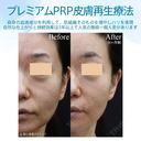 【40代女性・目の下とほうれい線で自然に若返り】プレミアムPRP皮膚再生療法（半年後） after画像 サムネイル用