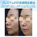 【40代女性・目の下とほうれい線で自然に若返り】プレミアムPRP皮膚再生療法（半年後） after画像 サムネイル用