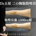 二の腕脂肪吸引 after画像 サムネイル用