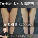 大腿脂肪吸引 before画像 サムネイル用