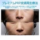 【30代女性・目の下、ほうれい線をナチュラルに目立たなく】プレミアムPRP皮膚再生療法（術後3ヶ月） before画像 サムネイル用