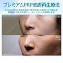 【30代女性・目の下、ほうれい線をナチュラルに目立たなく】プレミアムPRP皮膚再生療法（術後3ヶ月） 90日後 サムネイル用