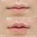 加賀ヒアル×リップ before画像 サムネイル用