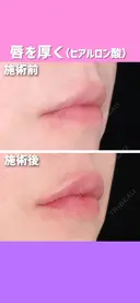 唇を厚く（ヒアルロン酸） before画像 サムネイル用