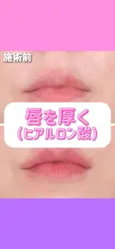 唇を厚く（ヒアルロン酸） after画像 サムネイル用