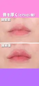 唇を厚く（ヒアルロン酸） after画像 サムネイル用