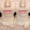 あごヒアルロン酸 after画像 サムネイル用