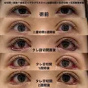 全切開＋眼瞼下垂修正＋グラマラスライン結膜切開＋目尻切開＋目尻靱帯移動＋裏ハムラ 14日後 サムネイル用